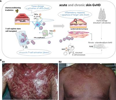 Established and Emerging Treatments of Skin GvHD